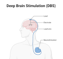 12. Điều trị phẫu thuật kích thích não sâu